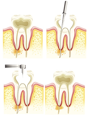 Tucson Root canals for Patient