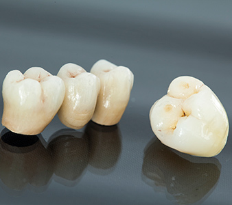 Tooth Crown Tucson - Dental Bridges