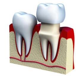 Tooth Crown Tucson - Dental Crowns